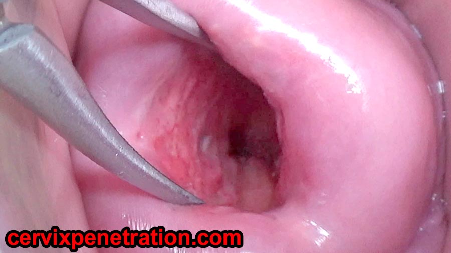 Asian Cervix Dilatation Stretching to watch inside Uterus